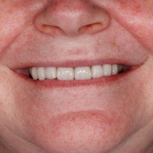 Veneers and Bridge