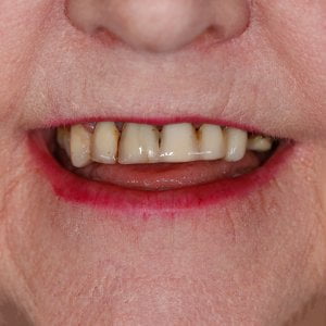 Porcelain Crowns & Bridges
