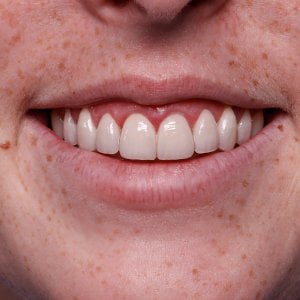 Gum Surgery & Porcelain Veneers