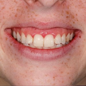 Gum Surgery & Porcelain Veneers